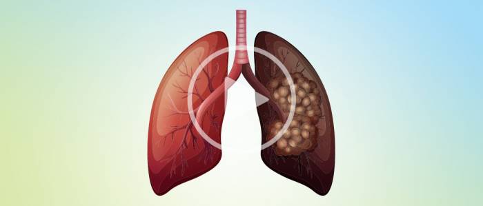 Nouveau webinaire : Cancer du poumon non à petites cellules (CPNPC) avancé ou métastatique...